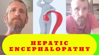 Hepatic Encephalopathy Strikes Back  Liver Cirrhosis Vlog [upl. by Nylyak]