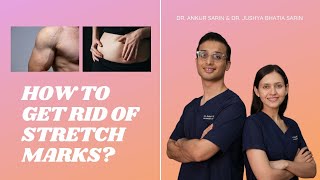 Stretch Marks Removal Treatment  Stretch marks pregnancy  DR ANKUR SARIN AND DR JUSHYA BHATIA [upl. by Daniell]