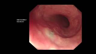 OESOPHAGEAL TRACTION DIVERTICULA amp ANTHRACOSIS POST TB [upl. by Savill]