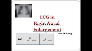 ECG in Right Atrial Enlargement Dr Akif Baig [upl. by Penthea196]