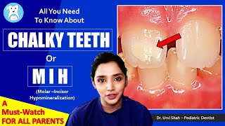 Chalky teeth  All you need to know about chalky teeth or MIH or Molar Incisor Hypomineralization [upl. by Nester226]