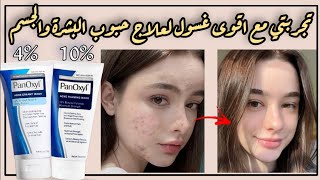 افضل غسول لعلاج الحبوب  العلاج السحري للحبوب  غسول بانوكسل لحبوب البشرة والجسم Panoxyl acne wash [upl. by Pooi]