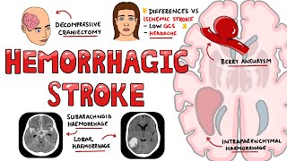 Hemorrhagic Stroke  Intracerebral Hemorrhage amp Subarachnoid Hemorrhage  Management [upl. by Bumgardner]