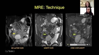 CT Versus MR Enterography PointCounterpoint [upl. by Jilly]