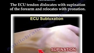 Extensor Carpi Ulnaris Subluxation  Everything You Need To Know  Dr Nabil Ebraheim [upl. by Ardnassela]