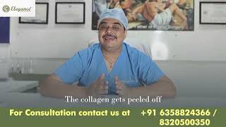 Second Degree Burn Treatment By Best Doctor For Reconstructive Surgeon Ahmedabdad Surat Gujarat [upl. by Joshuah458]