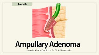 Ampullary Adenoma [upl. by Lorenza]