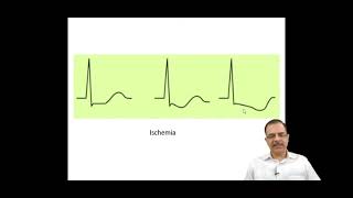 Ecg ischemia [upl. by Treulich965]