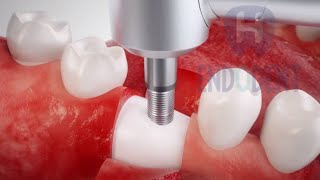 Colocación de implantes dentales paso a paso vídeo animado [upl. by Yolane]