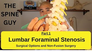 Lumbar Foraminal Stenosis  Surgical Options and NonFusion Surgery [upl. by Alexei]