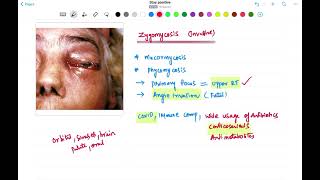 Mucormycosis  MUST DO  INBDE  NEET MDS  INICET MDS  BDS  ORAL MEDICINE [upl. by Gnoz152]