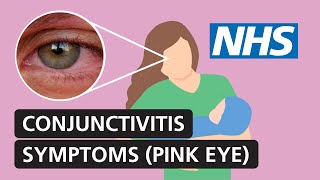 Conjunctivitis symptoms and treatment for red itchy watery eyes  NHS [upl. by Enirehtakyram]