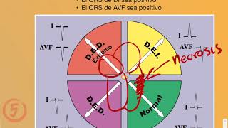 Tema 3 Interpretación electrocardiográfica de las anomalías del músculo cardíaco [upl. by Edie]