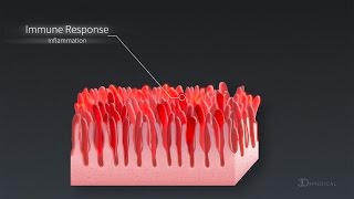 What is Celiac Disease  World Digestive Health Day [upl. by Achorn715]