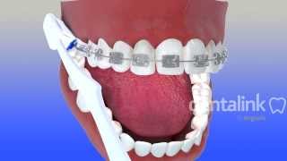 Cepillado de dientes con brackets TÉCNICA CORRECTA  Video 3D [upl. by Adnik394]