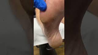 Watch an Aussie podiatrist tackle a stubborn forefoot callus PodiatryMagic FootCareDownUnder [upl. by Lanza938]