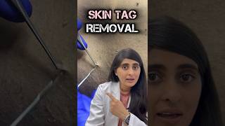 Skin tag removal  Skin tags on neck  How to remove skin tag [upl. by Tammy]