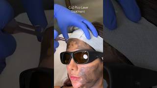 Co2 Pico Laser Treatment at CARA [upl. by Yblocaj969]