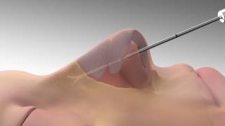 LATERA Animation for Patients with Nasal Congestion [upl. by Nylinej693]