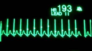 Supraventricular Tachycardia with Synchronized Cardioversion [upl. by Halyahs]