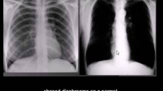 Chest xray interpretation COPD emphysema [upl. by Aisile]