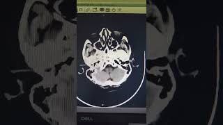 GBM Glioma Glioblastomamultiforme sagitalsinus [upl. by Ecissej]