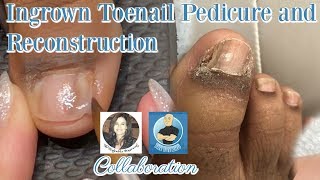 Pedicure with Toenail Reconstruction After Ingrown Toenail Removal with The Toe Bro [upl. by Eniamurt531]