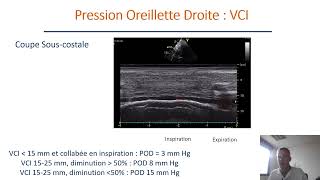 Evaluation de la fonction diastolique en échocardiographie transthoracique [upl. by Ponton81]