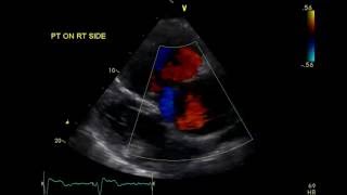 Congenitally Corrected Transposition of Great Arteries  TTE [upl. by Dionysus403]