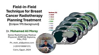 Field in Field Technique for Breast Cancer Radiotherapy Planning Treatment [upl. by Irena]