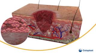 TISSUR REPAIR Part 3 WOUND HEALING Factors affecting wound healing [upl. by Aicia247]