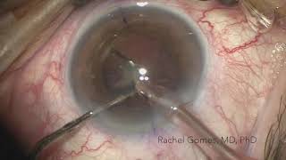 FINEVISION TORIC implantation by Dra Rachel Gomes [upl. by Dnivra519]