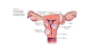 Mayo Clinic Minute  Can uterine fibroids affect pregnancy [upl. by Euqor241]