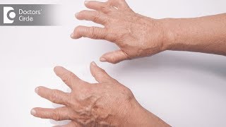 Signs and symptoms of Rheumatoid Arthritis  Dr Prashanth Jain [upl. by Kirred]