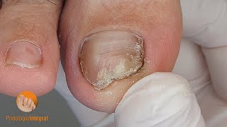 Nail psoriasis and onycholysis  Nail trimming and cleaning of the grooves Podología Integral [upl. by Nehepts125]