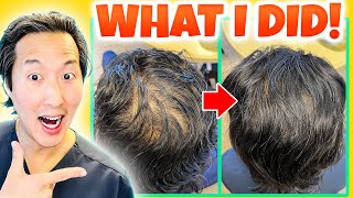 How to treat hair thinning in front part of the scalp  Dr Nischal K [upl. by Elset542]