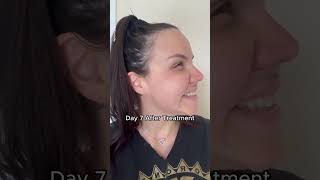 Botox Crows Feet Angry 11s amp Botox Forehead Lines  Botox Full Face Transformation [upl. by Senga]