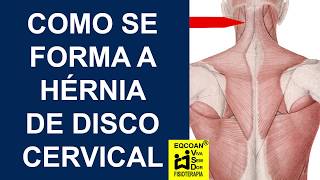 Como se forma a hérnia de disco cervical [upl. by Anaujal918]