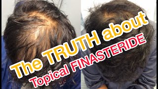 Topical Finasteride  Minoxidil results after 6 Months [upl. by Coe]