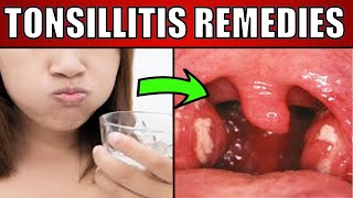 Homeopathic Medicines for Tonsillitis [upl. by Krystyna]