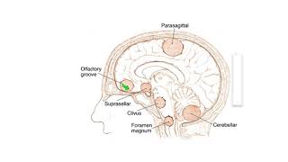 Meningiomas Signs Symptoms and Advanced Treatment Options [upl. by Rehpotsrhc414]