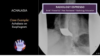 ACHALASIA Case Example  ACHALASIA of an Esophagram 4630 [upl. by Mathilde]