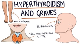 Understanding Hyperthyroidism and Graves Disease [upl. by Giulietta]