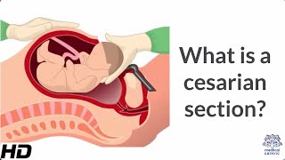 What is a Cesarian Section [upl. by Gildus]