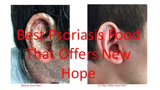 EnerFlex Nutrition  Case Studies on Scalp Plaque and Erythrodermic Psoriasis Updated 42016 [upl. by Jordon]