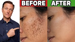 How to Get Rid of Hyperpigmentation Aging or Dark Spots [upl. by Minda]