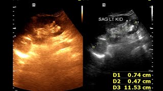 Hydro nephrosis  Renal cortical cyst  Renal calculus [upl. by Ecnarrat452]