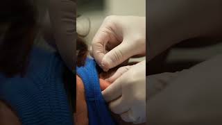 😲 Dry Needling the Traps dryneedling physicaltherapy runner exercise satisfying asmr needle [upl. by Greenes341]