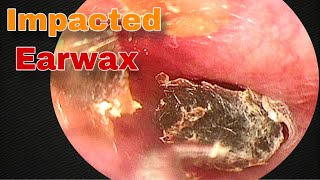 Impacted Ear Wax Removal  Doctor Anh [upl. by Nanreik]