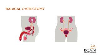 What is a cystectomy [upl. by Meuser464]